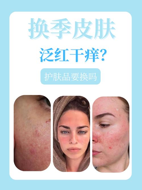 纤体霜中哪些刺激成分可能导致皮肤过敏或发炎？