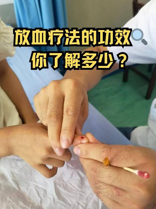 中医放血疗法真的能帮助减肥吗？