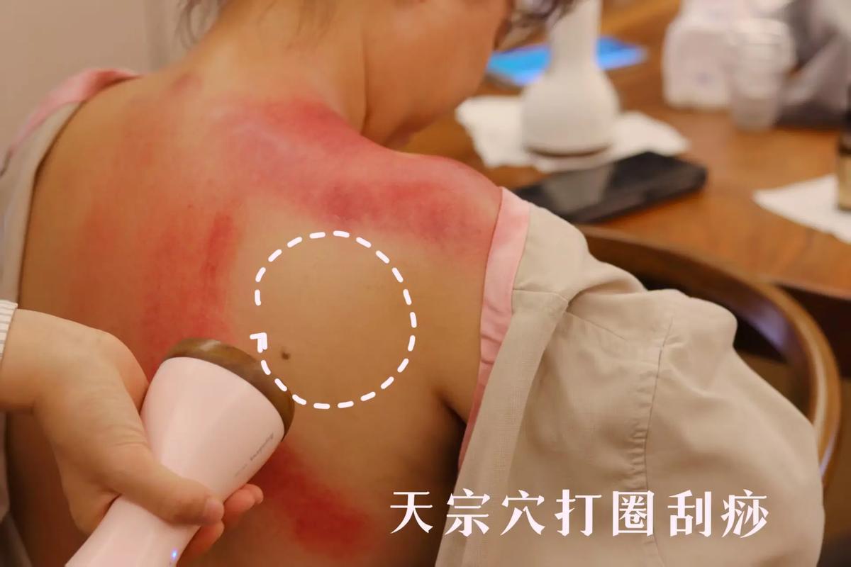 刮痧真的能让我排毒减肥，瘦到尖叫吗？