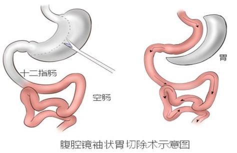腹腔镜束带式胃减容手术是什么？