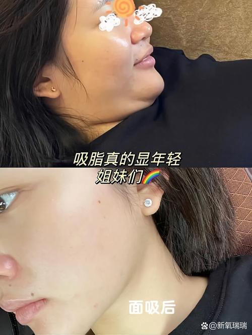 吸脂瘦脸术能让我成为上镜美女吗？