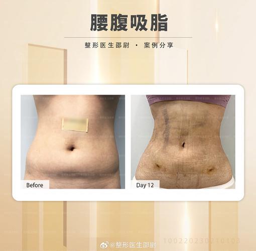 吸脂减肥真的能让杨柳细腰成为现实吗？