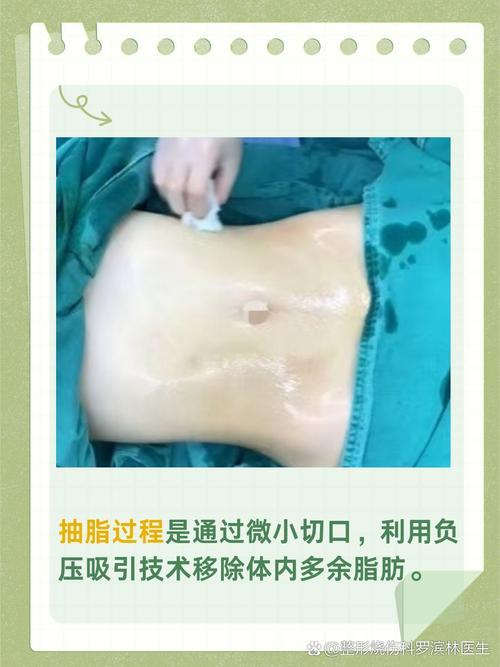 哪些人群适合进行聚能吸脂减肥手术？