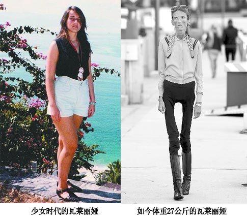 减肥过度变成活骷髅，女子体重仅剩27公斤，这是怎么回事？