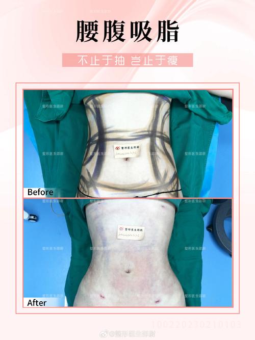 吸脂手术主要是改善外形还是体重？