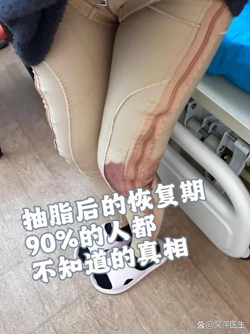 女友抽脂手术过程和恢复情况，有详细记录吗？