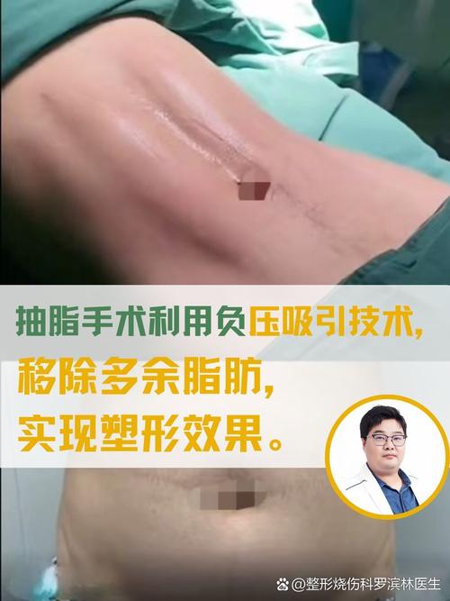 哪些人群适合进行聚能吸脂减肥手术？