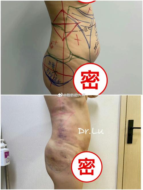 抽脂减肥前，有哪些关键问题是一定要问清的？