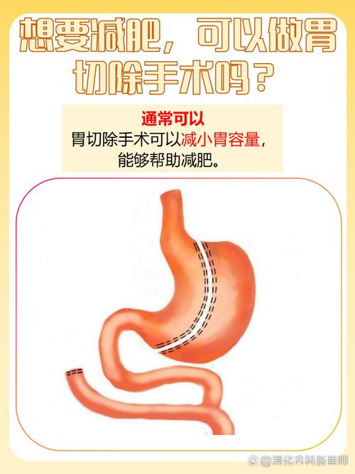我这种情况可以做束胃减肥手术吗？适合我吗？