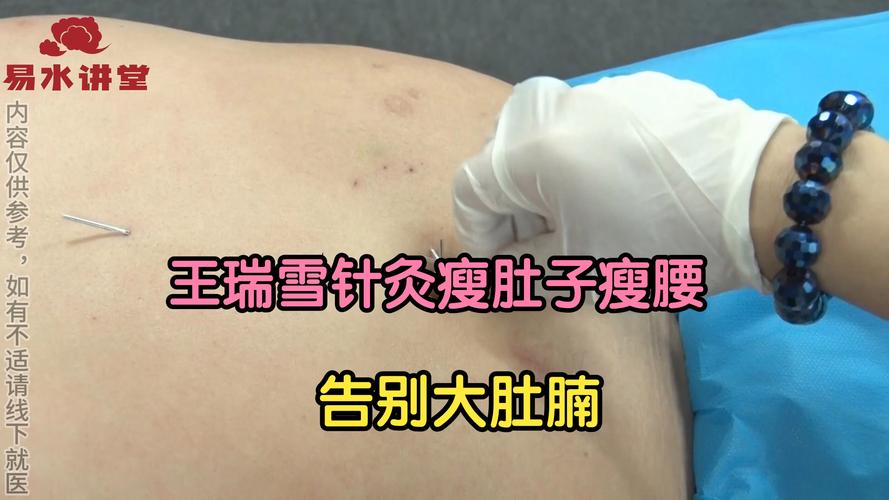 针灸减肥真的能彻底甩掉我的啤酒肚吗？