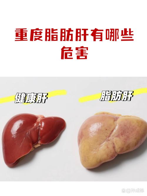 脂肪肝有哪些潜在严重危害？