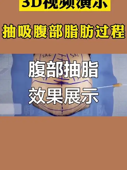 抽脂手术针对局部肥胖部位，哪种方法最有效呢？