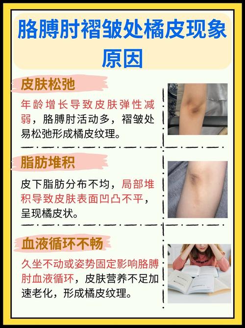 为什么皮肤容易出现橘皮组织现象？