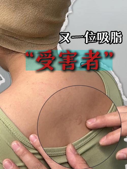 抽脂手术如果盲目进行，会有哪些可怕的后果呢？