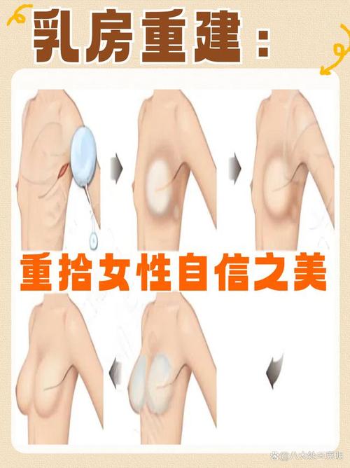 乳房再造后如何让自信再添几分？