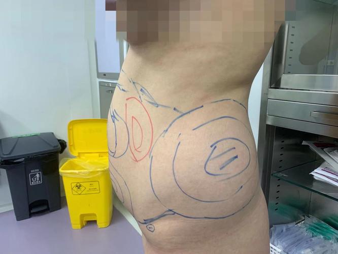 激光抽脂减肥有哪些显著优势？