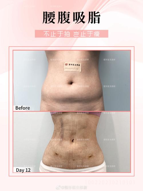 吸脂手术主要是改善外形还是体重？