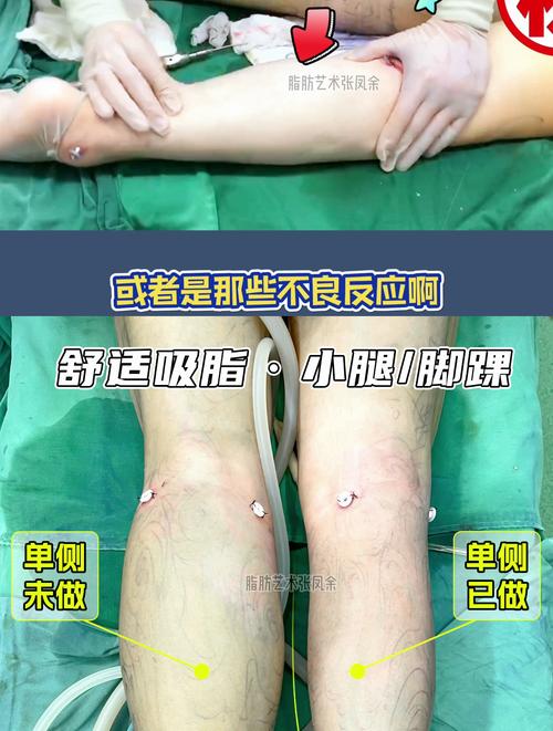 小腿吸脂后如何塑造更加迷人的细腿效果？
