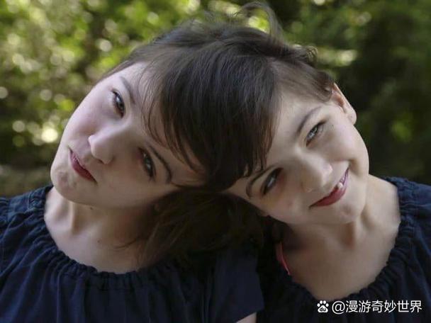 加拿大双胞胎减肥一人险丧命，他们成功了吗？