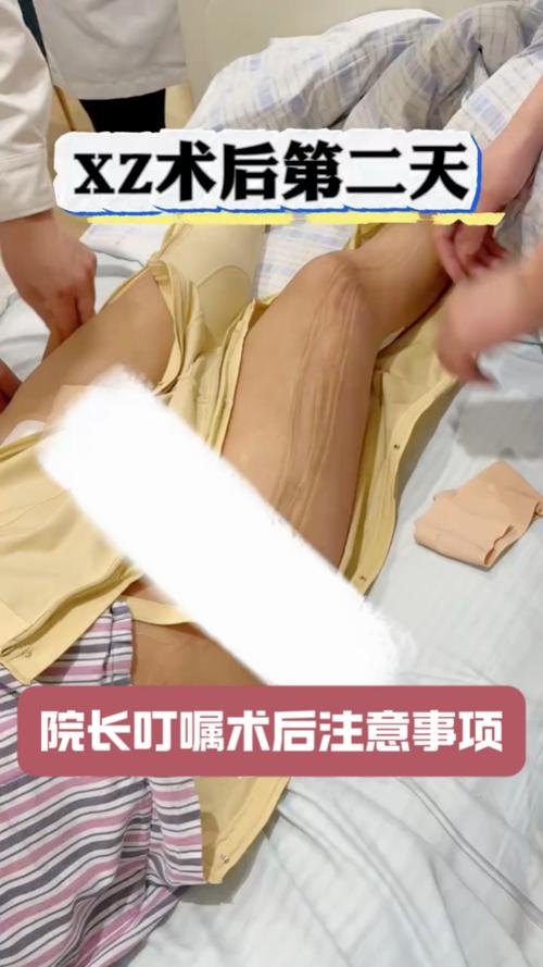 抽脂减肥后效果显著，有没有人分享过自己的真实体验和感受？