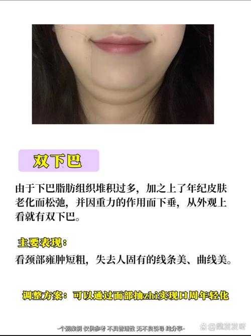 面部吸脂术适合哪些具体人群或情况？