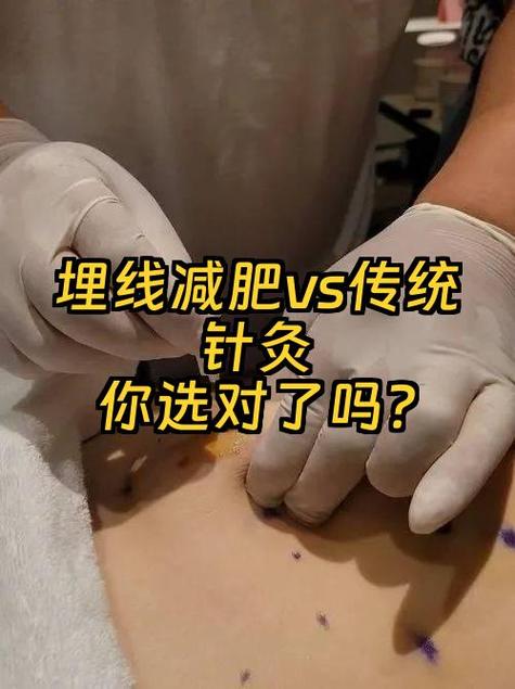 针灸和埋线减肥有什么不同效果？