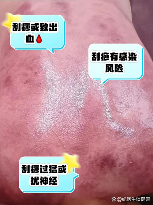 刮痧减肥需看体质吗？盲目行动会有哪些危害？
