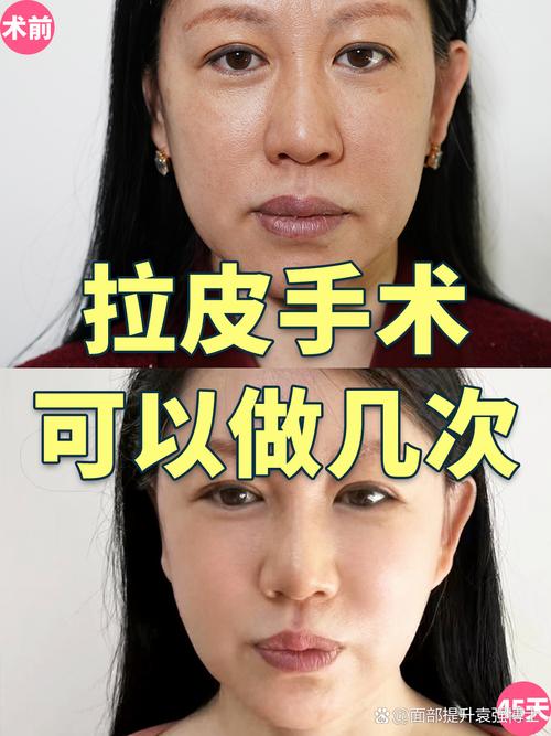 如何挑选合适的外用瘦身霜来达到理想瘦身效果？