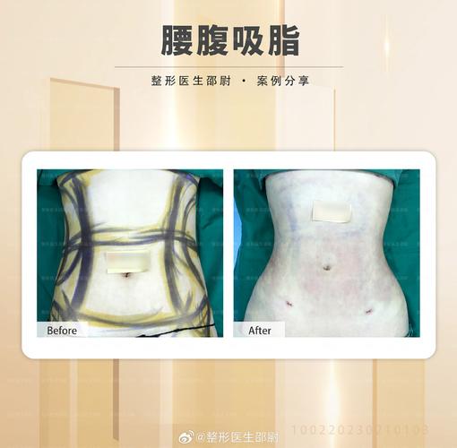 吸脂减肥真的能让杨柳细腰成为现实吗？