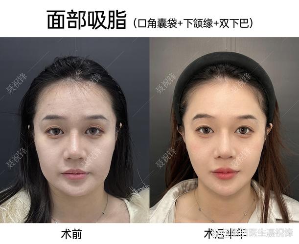 脸部细微抽脂术能帮我换发年轻活力吗？