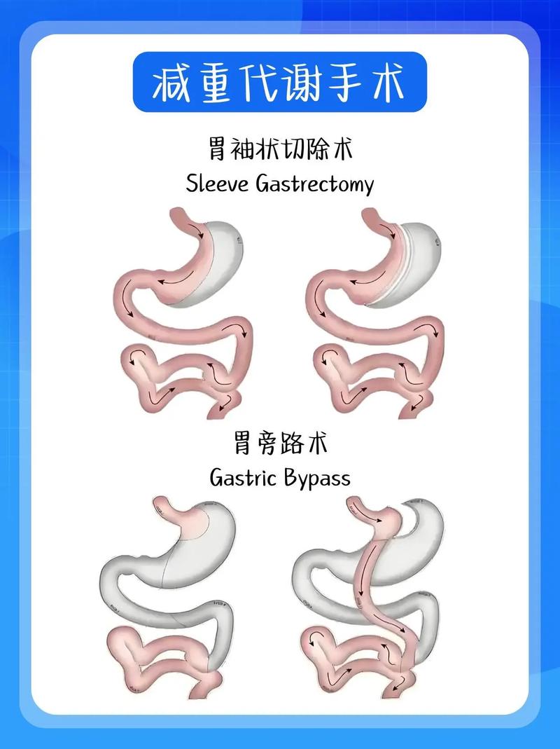 胃旁路手术减肥成功的关键是否在于高超的外科技术？