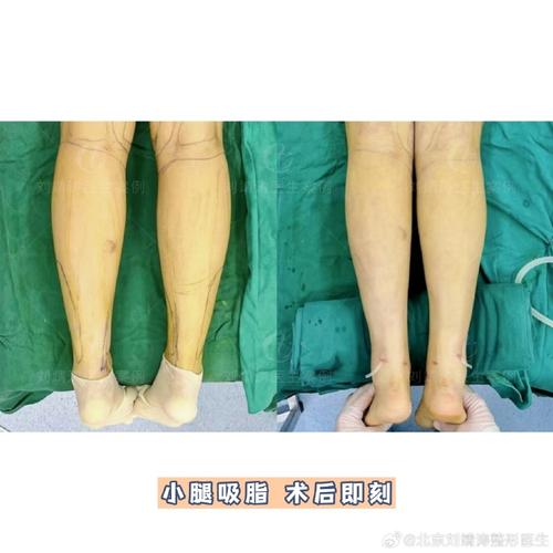小腿吸脂后如何塑造更加迷人的细腿效果？