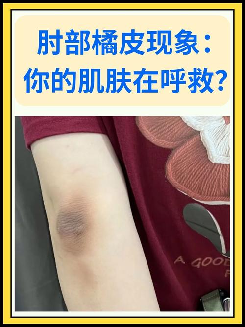 为什么皮肤容易出现橘皮组织现象？