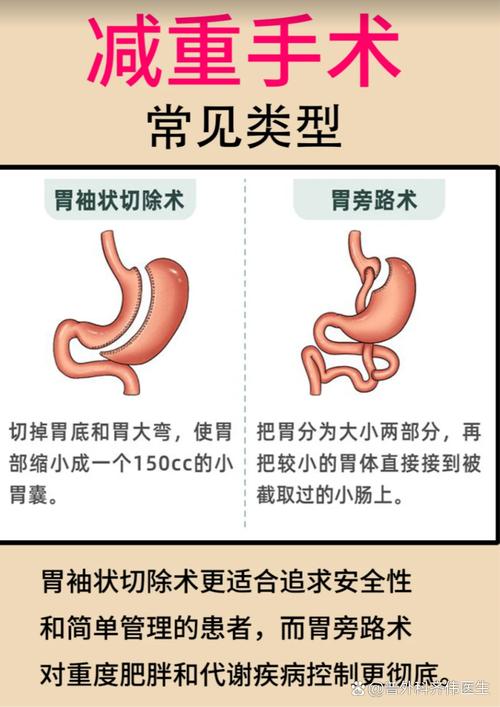 胃绕道手术能否有效控制食欲，达到减肥目的？