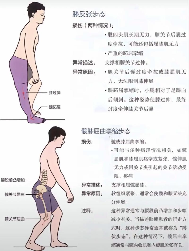 如何避免这5种可能导致胖腿的不良走姿？