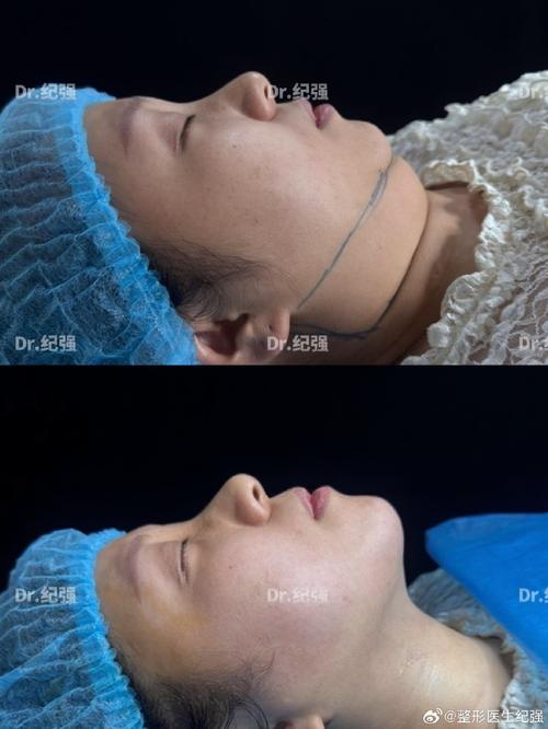 颈部抽脂术能彻底去除双下巴，让无痕效果立竿见影吗？