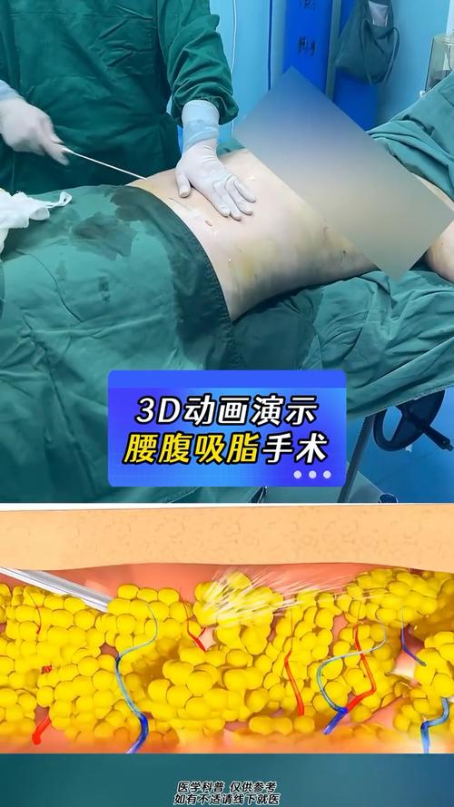 腹部吸脂减肥术是哪种整形手术？