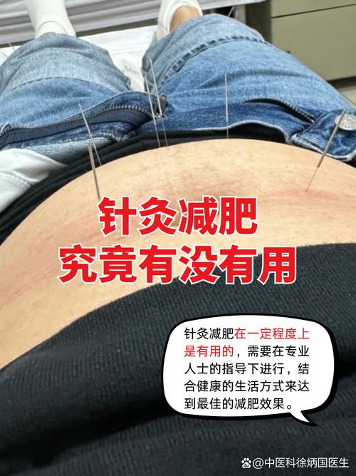 针灸减肥真的能一劳永逸，无需再努力吗？