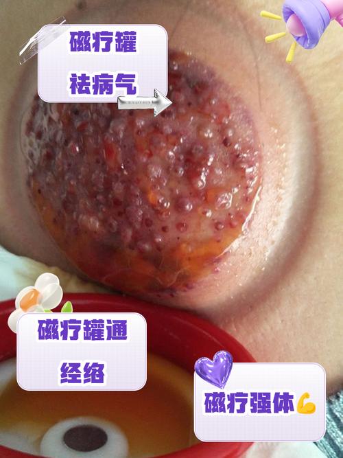 磁罐经络减肥效果真的好吗？一级棒的瘦身效果是真的吗？