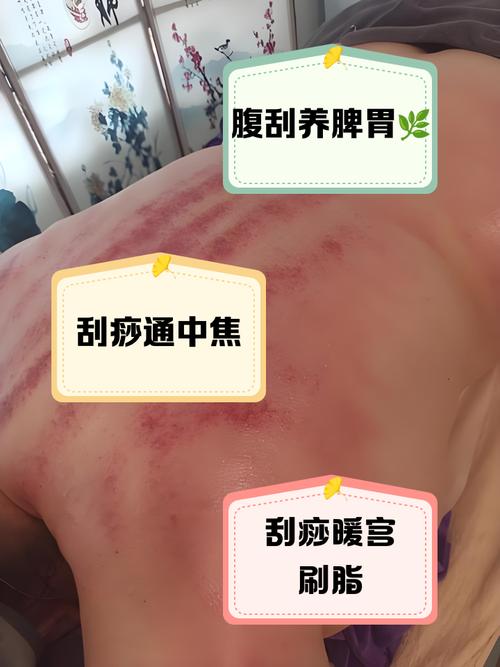 如何通过刮痧轻松减掉5大部位脂肪？