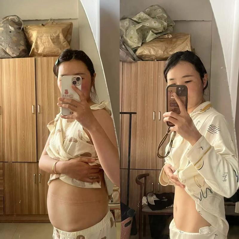 女孩减肥后皮肤松弛，割掉腹部8斤肉需要花费多少巨资？