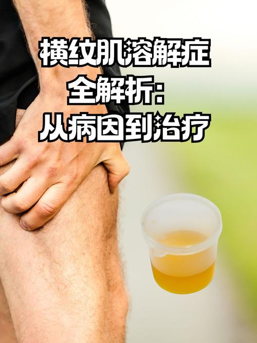 为什么减肥狂跑3天的女孩会患上横纹肌溶解症？