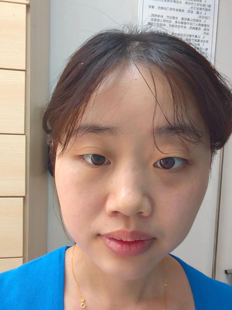 颜面针灸瘦脸效果如何？有没有推荐的专家？