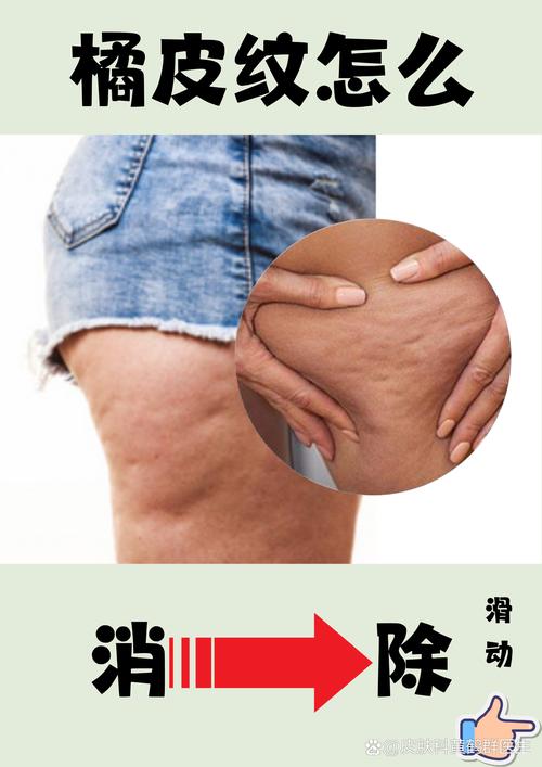 按摩减肥可以去除身上的橘皮纹吗？