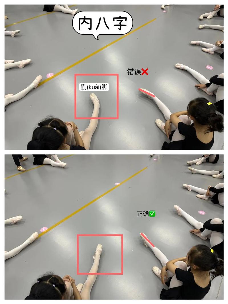如何纠正W坐姿导致的内八字腿问题？