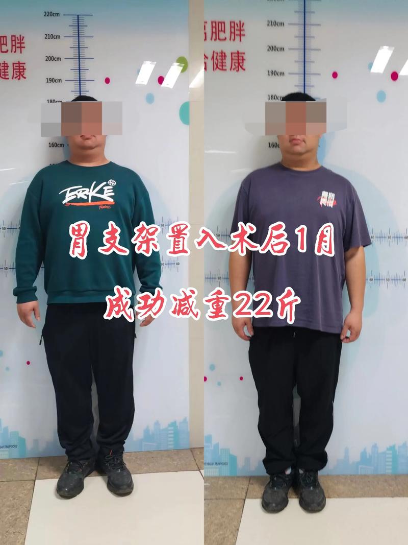 胃肠减肥手术适合体型较胖的资深人士吗？