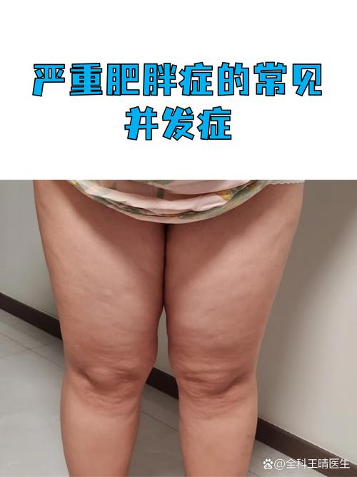 胖爸爸要注意了吗？小心胖基因真的会遗传吗？