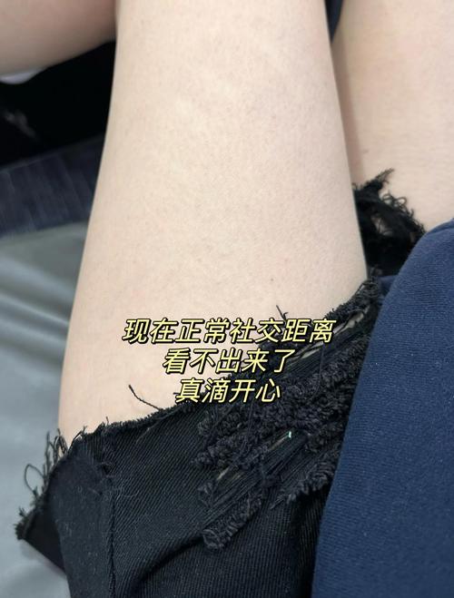减肥后皮肤松弛肥胖纹怎么快速消除？