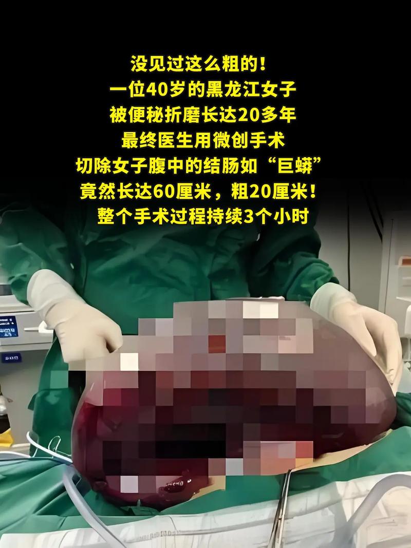欧美流行的残忍割肠减肥手术，真的安全有效吗？