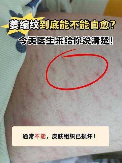 如何有效预防减肥过程中出现的肥胖纹？